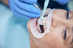 Dantų kanalų valymas - slėnio odontologijos klinika