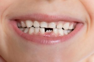 Nuskilęs dantis | Slėnio odontologijos Klinika